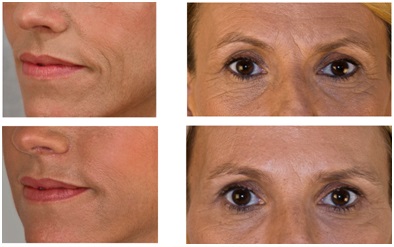 Fillers treatment on Accordian Lines & Frown Lines Source: Allergan photo library