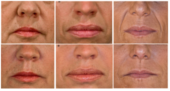 Fillers Treatment on Nasolabial Folds. Source: Allergan photo library