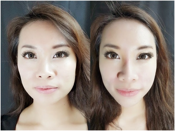 Sarah May Low, Blogger and Celebrity Fitness Ambassador Before & After Fillers Treatment at Mediviron UOA