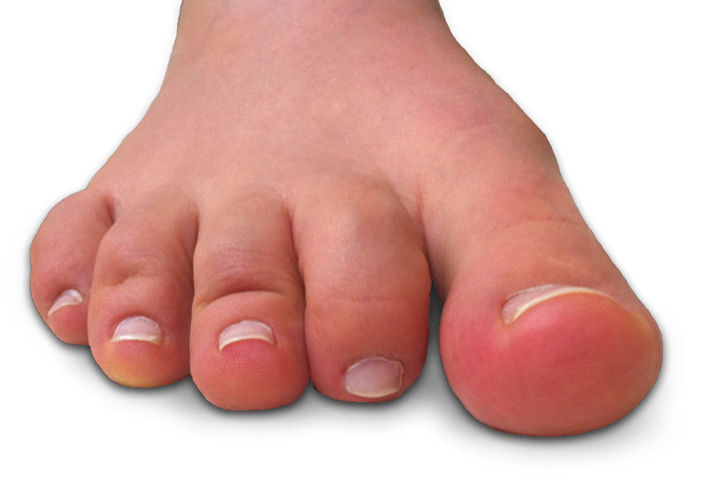 What causes toes to curl under?