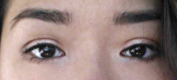 A closeup on my eyes with makeup on, one week after the procedure