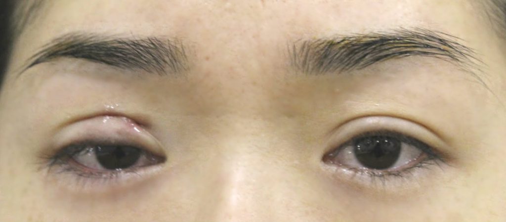 My right eyelid after the procedure