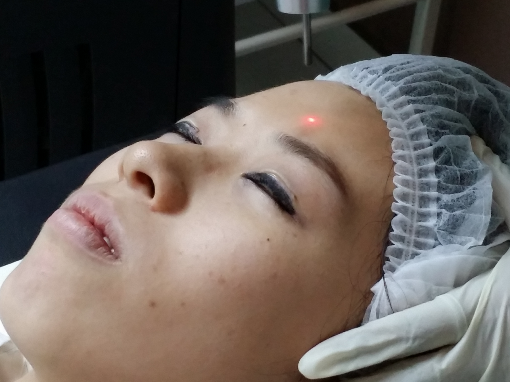 Medlite Laser can treat sun spots, brown spots and uneven skin tone.