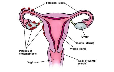 Photo: Endometriosis UK